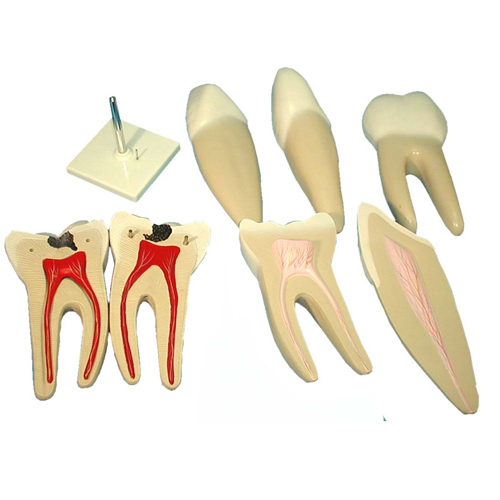 正常牙與蛀牙解剖模型